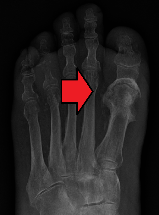 Osteomalacia Explained: Causes, Symptoms, and Soft Bone Solutions